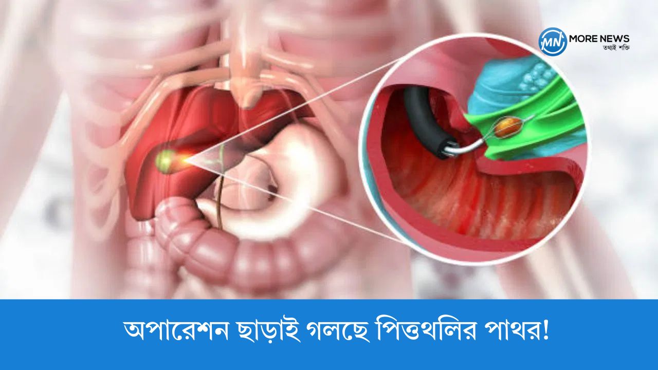Gallstones dissolve without surgery!