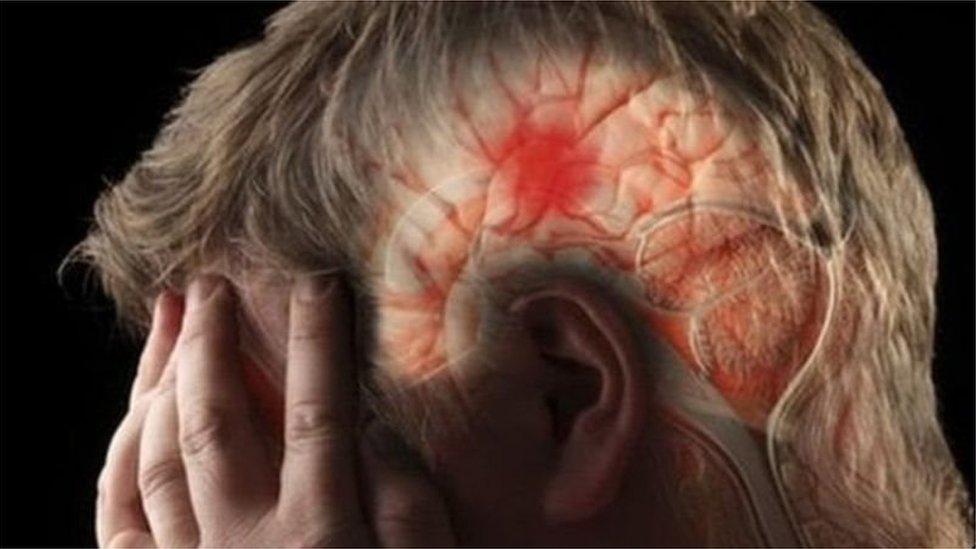 &ldquo;Golden Time&rdquo; Treatment for Stroke: Thrombolysis Can Save Lives