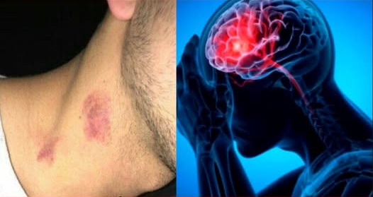 Death from &lsquo;Love Bite&rsquo;! Hickey given by lover takes teenager&rsquo;s life