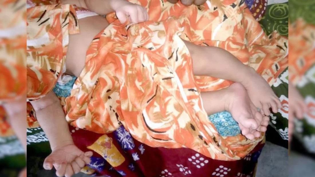 ফুলবাড়ীতে ২৮ আঙুল নিয়ে কন্যাশিশুর জন্ম